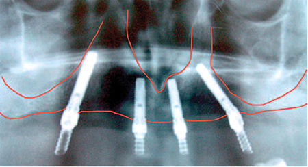 Treatment planning with dental implants – Maxilla.