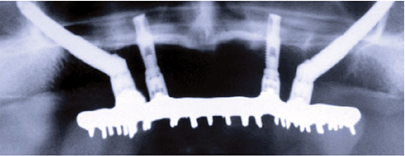 Treatment planning with dental implants – Maxilla.