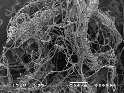 Remnants of tufted floss being removed from around the implant. Photo courtesy of Marco Montevecchi, DDS, PhD, Bologna, Italy.
