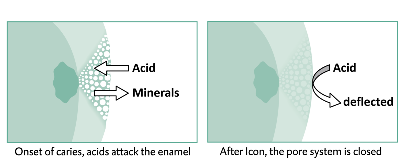 Resin Infiltration Revolutionizing the Way We Treat Early Caries