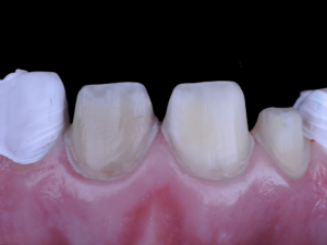 Figure 2: Prepared teeth