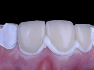 •Figure 3: Seated restoration with excess cement