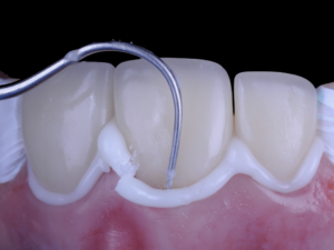 Figure 4: Excess removal with an explorer