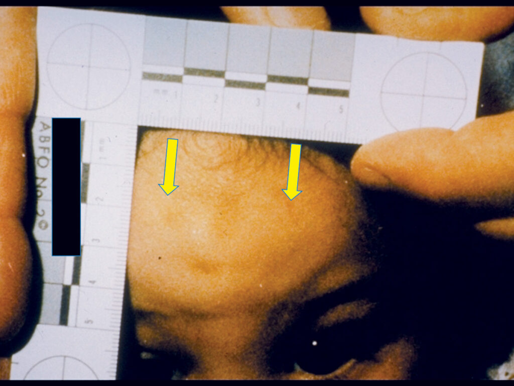 Oval bruise on forehead was not from fall, but an adult bite mark.