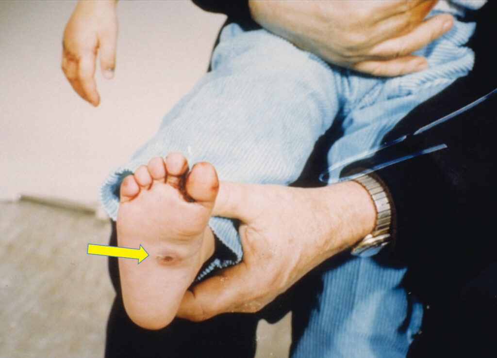 Confirmed third-degree cigarette burn on sole of the foot.
