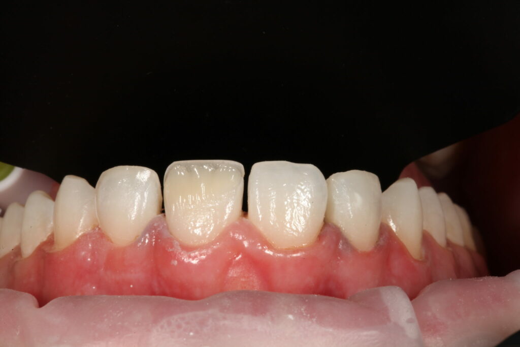 An Economic Way to Complete Costly Orthodontic Treatments with