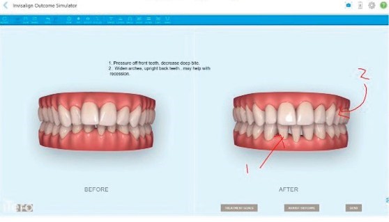 DT News - US - Spotlight on Invisalign: Pros and cons of treatment planning  with clear aligners