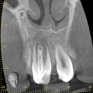 Coronal