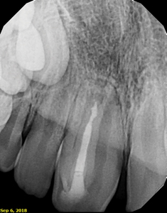 Periapical radiograph