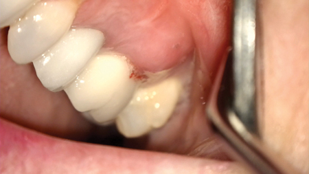 Buccal swelling over tooth #14.