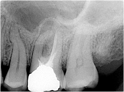 Consider very guarded endodontic and/or restorative prognosis for tooth #14