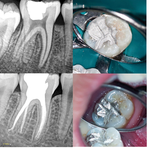 Case of Dr. Viraj Vora. A. Lower right molar with pulp necrosis. B. Post-operative amalgam restoration. Three year C. radiographic and D. clinical follow-up.