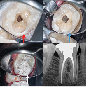 Case of Dr. Viraj Vora. A. Following access cavity and caries/old restoration removal, the remaining disto-lingual wall is thin, weak and more prone to structural failure (red arrow). B. The disto-lingual wall is reduced by 1.5mm to 2mm (blue arrow) and C. covered with restorative material (white arrow). D. Post-operative radiograph.