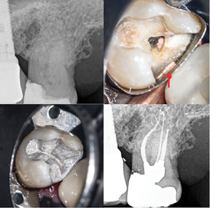 Case of Dr. Viraj Vora. A. Upper molar with Irreversible Pulpitis. B. After placement of the matrix band, heated gutta percha is used to closed the gap caused by the root concavity (red arrow). C. Amalgam restoration with carving of primary anatomy. D. Post-operative radiograph.