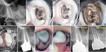 Case of Dr. Viraj Vora. A. Upper molar missing significant amount of tooth structure. B. & C. Retreatment is completed and D. a combined Tofflemire band and custom resin matrix is used to to place the amalgam core. E. The distal crown finishing line is prepared on restorative material. F. Post-operative radiograph. G. & H. Crown with distal margin placed on the restorative material. Soft tissue health is maintained at the 1 year follow-up. I. 1 year and J. 3.5 years radiographic follow-up.