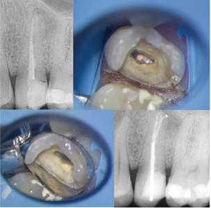Case of Dr. Bobby Nadeau. A. Pre-operative radiograph of an upper second premolar with lack of ferrule on the distal aspect. B., C. & D. Following root canal retreatment, the tooth is restored using a metal post and composite resin core build-up.