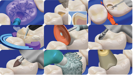 Courtesy of Dr. David Clark. Steps involved in the Biolcear Method. A. Biofilm disclosing solution. B. Biofilm removal using air polishing. C. Pre-wedging and cavity preparation refinement. D. Use of a clear, tooth form sectional matrix, tooth form wedge and separation ring. Injection overloading using heated composite resin. Finishing and polishing using E. finishing discs, F. carbide bur, G. finishing point, H. polishing paste and I. polishing cup.
