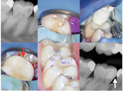 Case of Dr. Bobby Nadeau. A. Lower first molar with reversible pulpitis due to deep caries. B. After caries excavation, bleeding from two small pulp exposures was controlled. Direct pulp cap was completed and the tooth restored permanently using the Bioclear Method (Tacoma, USA) . Adaptation of clear Bioclear matrix, wedge and separation ring. C. Once placed, the composite resin restoration is polished using a polishing paste. E., F. & G. Adequate mesial contour (white arrow), interproximal (red arrow) and occlusal contacts are re-established.
