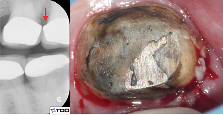 24A. Over-contoured crown margin (red arrow). B. Severe gingival inflammation is seen after removal of the defective crown.