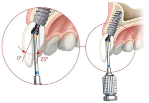 Screw Retention Feature Retention of Implant Prosthetics: Cohesion vs. Screw Retention. What’s ...