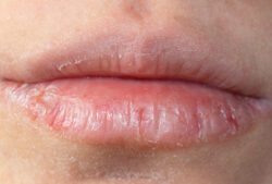 Lips: The Forgotten Oral Tissue - Oral Health Group
