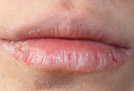 Unhealthy lips with poor barrier function, compared to healthy lips, well maintained with Lip-TxTM.