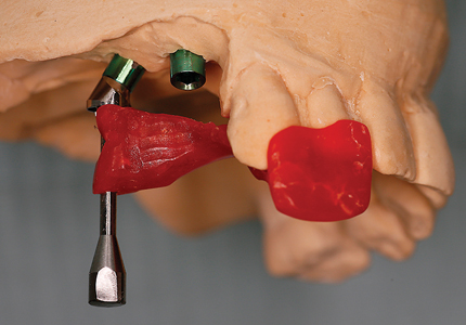 Duralay Stent #2 fabricated with handle carrier attached to #15 Multi-abutment.
