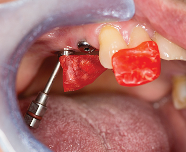 Multi-abutment #15 seated in correct position using Duralay stent.