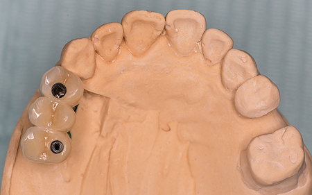 Fixed implant supported bridge on stone model.