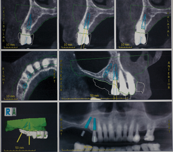 Implant Positions planned using CBCT data.