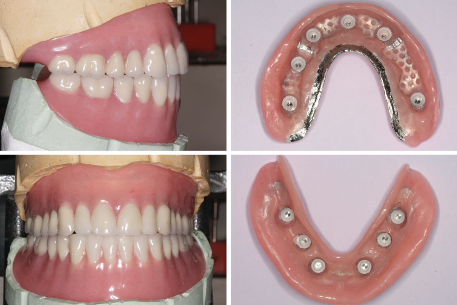 6 The final mounted dentures. Denture intaglio surfaces, showing the