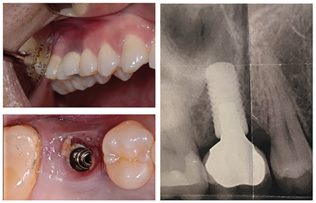 tooth implant problems