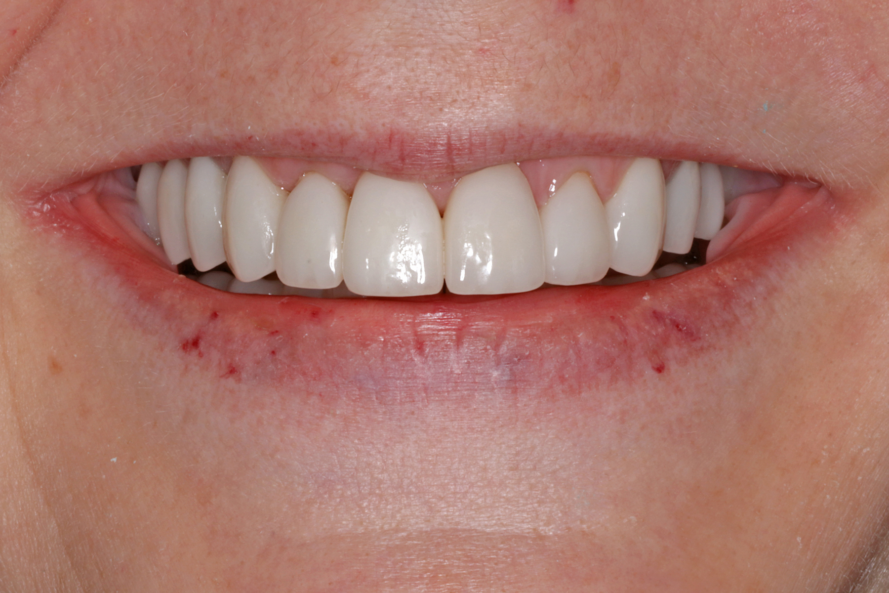 Figure 42 Case 3 Final Smile Layered Lithium Disilicate Crowns Oral 