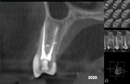 Cracked Teeth - St. Albert Endodontics