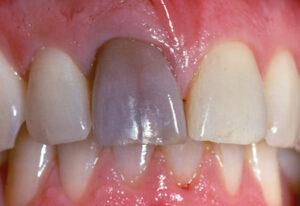 The anterior teeth would discolor due to untreated necrotic pulp. In this aesthetic situation, it is time to access, vacuum root canal system contents (this is good anyway, as latent bacteria could creep out from the foraminal seals), and then fill the root canal system. Then correct the discolored tooth with either “walking bleach” or veneer or maybe some futuristic paint!