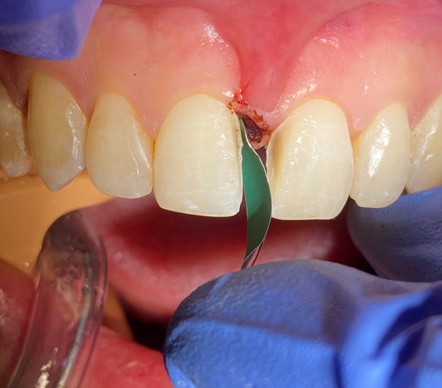 Finding a Place for Universal Composites in Esthetic Dentistry Oral