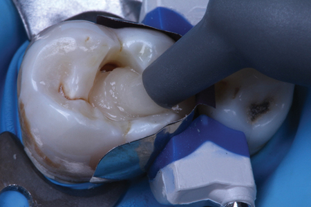 Heated Phil Nano (Dental Savings Club) composite resin injected into tooth preparation.