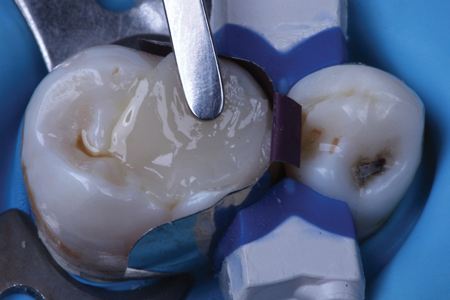 Heated Phil Nano (Dental Savings Club) composite resin adapted to walls of tooth preparation.