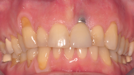 Removal of Osseointegrated Dental Implants - Oral Health Group