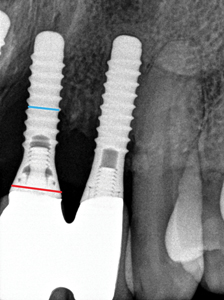 Explant / Dental Implant Removal - Leading Implant Centers