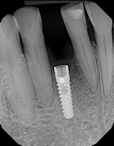 Removal techniques for failed implants