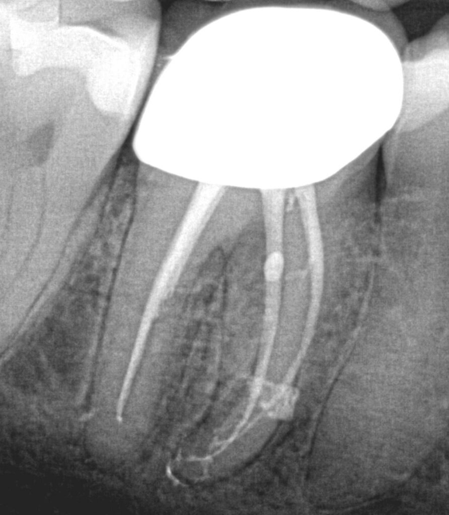 SWEEPS Modality Opens a New Era Digitally Pulsed Lasers, Endodontics