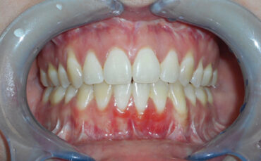 Presurgical Maxillary Segmented Orthodontics: A Simple Concept to ...