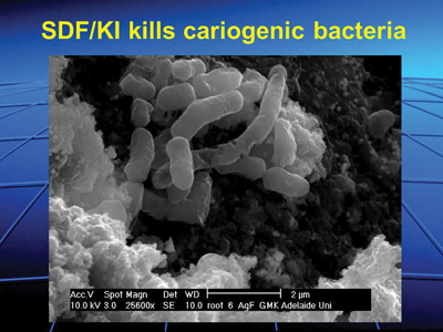 Shows the bactericidal effect of AgI deposited on the surface of carious dentin after SDF/KI treatment. 