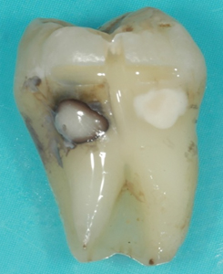 Demonstrates the effectiveness of SDF/KI in preventing staining compared to SDF alone. 