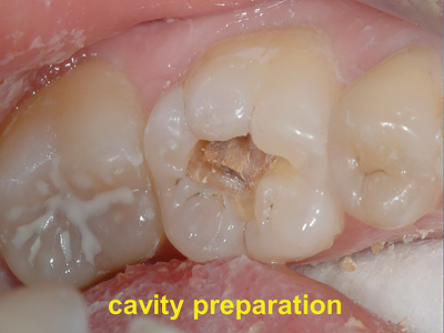  An occlusal cavity preparation with supported cusps for the restoration of caries prior to SDF/KI and a GIC overlay. 