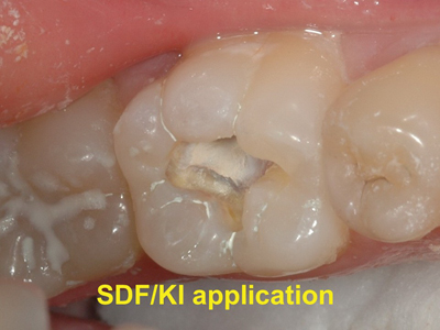 Following a 15 second etch, the caries has been treated with SDF and KI. Notice the white precipitate of AgI on the caries surface.