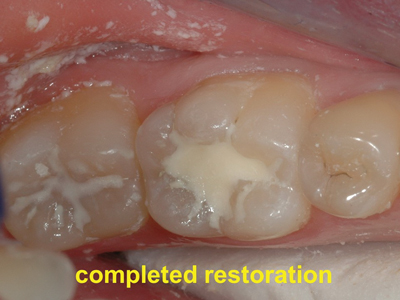  A wear resistant GIC restoration provides a simple and predictable solution for the management of single surface caries. 