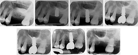 1A. Sinus lift procedure performed for #2.6 implant site preparation for a 55-year-old female patient (August 2016). 1B. Implant placed at #2.6 site (March 2017). 1C. Implant stage II procedure performed (June 2017). 1D. Implant #2.6 restored (November 2017). 1E. Follow-up appointment and continued maintenance therapy with no issues (November 2018). In 2019, the patient had a flare up of Irritable-Bowel-Syndrome (IBS) and was prescribed Pentaprazole (PPI) and Pinaverium Bromide. 1F. The implant was loose and there was loss of osseointegration (March 2021). 1G. The implant was lost as it fell out (April 2022)