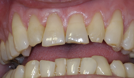  Class V abrasion restorations after 15 years. 